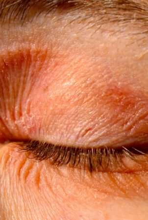 Close-up of red, inflamed eyelid showing eczema symptoms with visible irritation and scaling