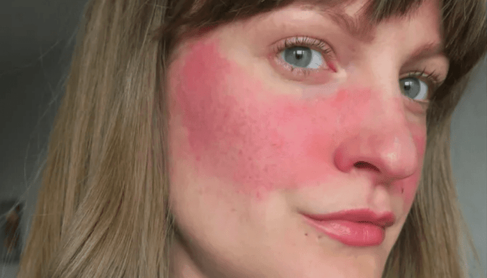 Young woman with visible facial rosacea showing redness and inflammation across cheeks and nose