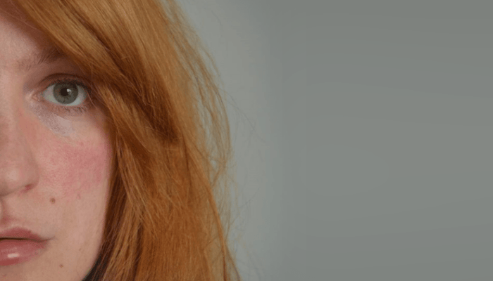 Close-up portrait showing half of a woman's face with rosacea symptoms including facial redness and sensitive skin