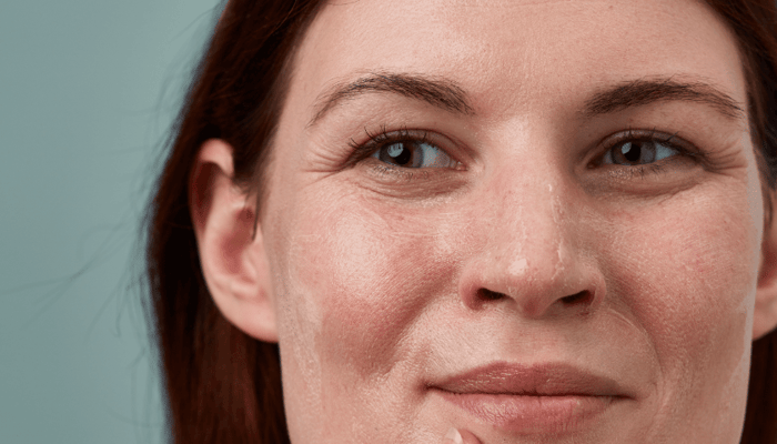 Close-up portrait of woman with visible rosacea showing facial redness and dilated capillaries on cheeks and nose