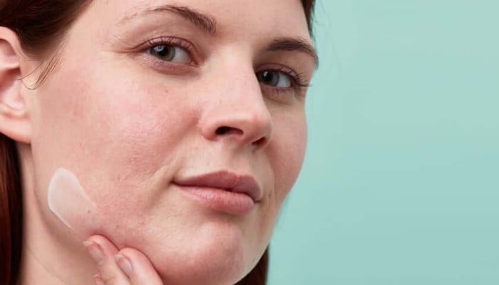 Young woman with sensitive skin applying face cream, visible facial redness and irritation