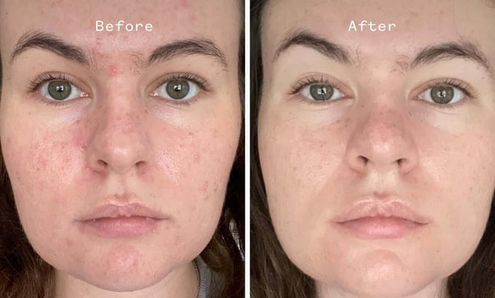 Before and after comparison showing reduced redness and breakouts on temples using Carbon Star sensitive skin treatment
