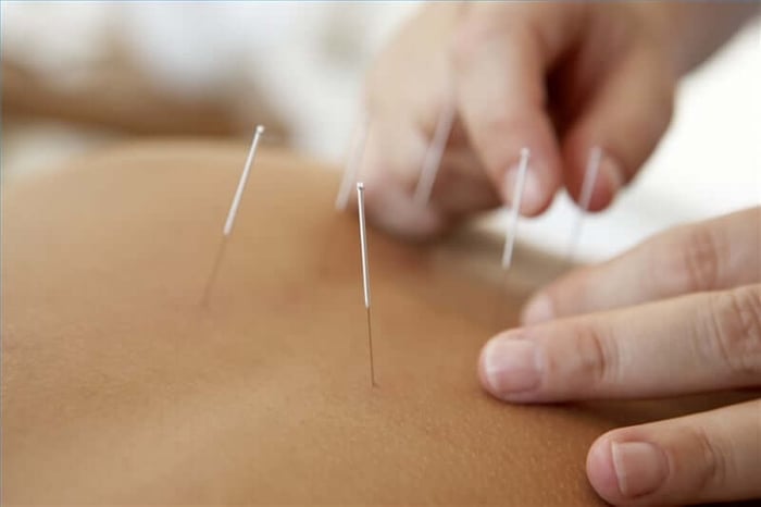 acupuncture