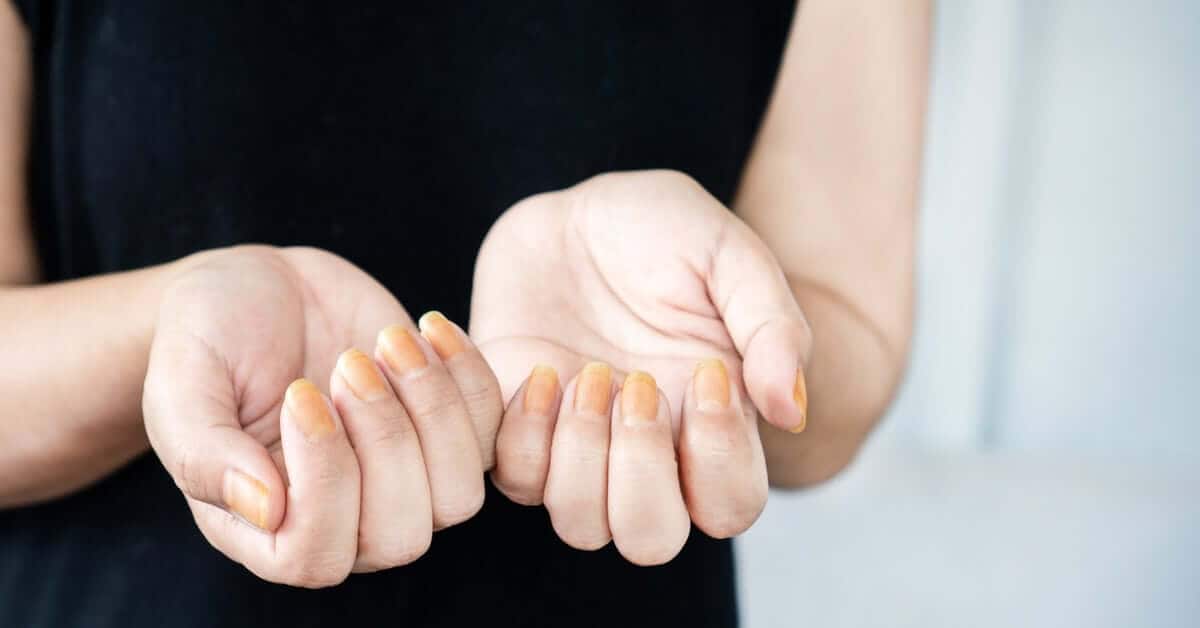 A person wearing a black t-shirt displays a close-up view of yellow nail fungus on their fingernails.