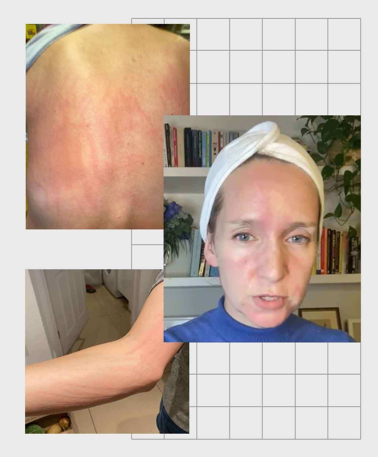 Woman showing chronic hives (urticaria) on face and arms with visible red raised welts on sensitive skin