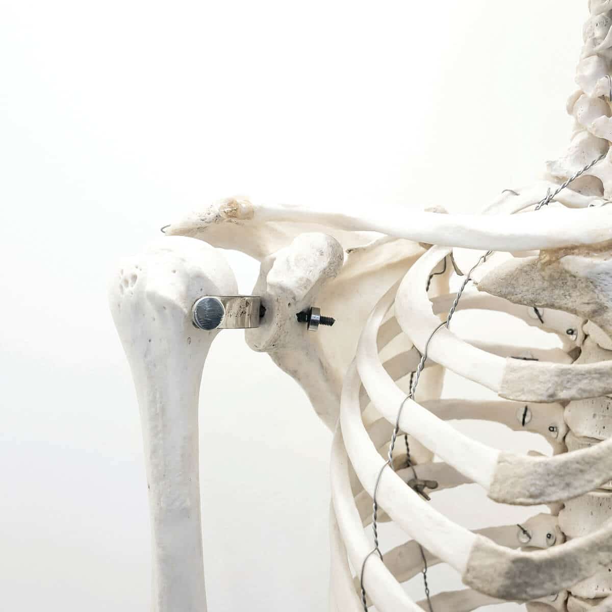 Calcium Deficiency for Bariatric Surgery Patients