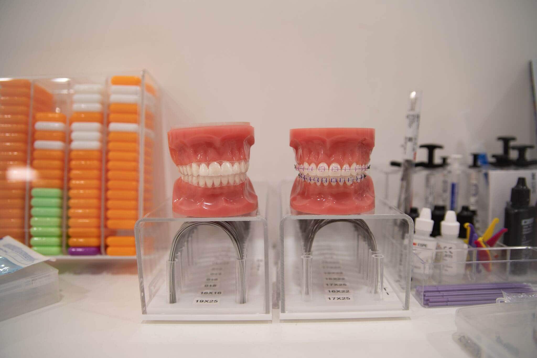 Dental models showing teeth with and without braces used for orthodontic education and treatment planning.