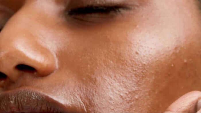 Close-up of woman's face showing hormonal acne breakouts on cheek and jawline area