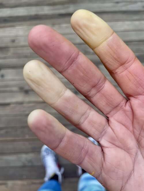 Hand showing Raynaud’s flare-up with pale and purple fingertips.
