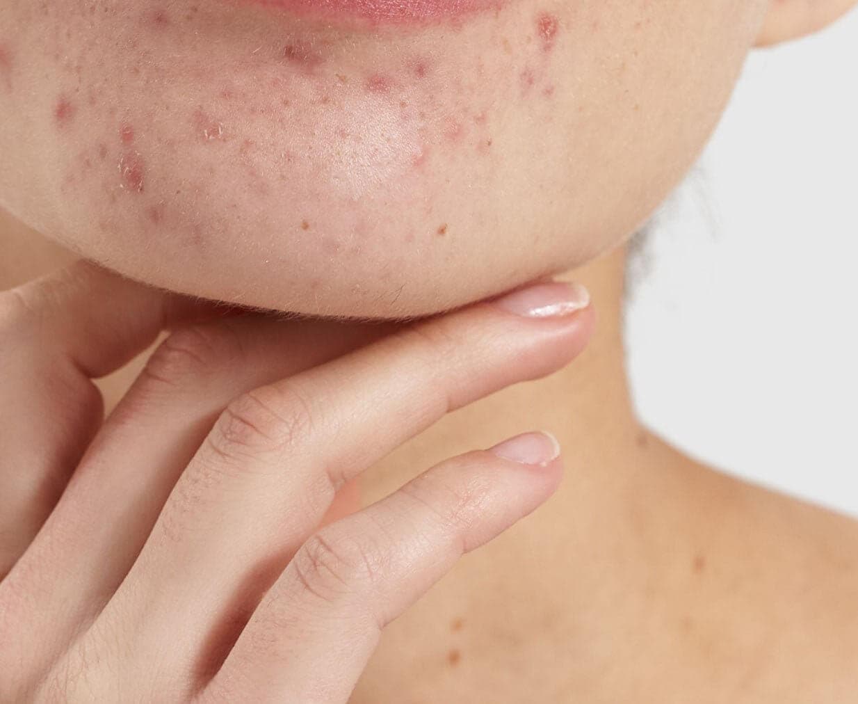 Close-up of chin and neck showing acne-prone skin with visible red blemishes and spots