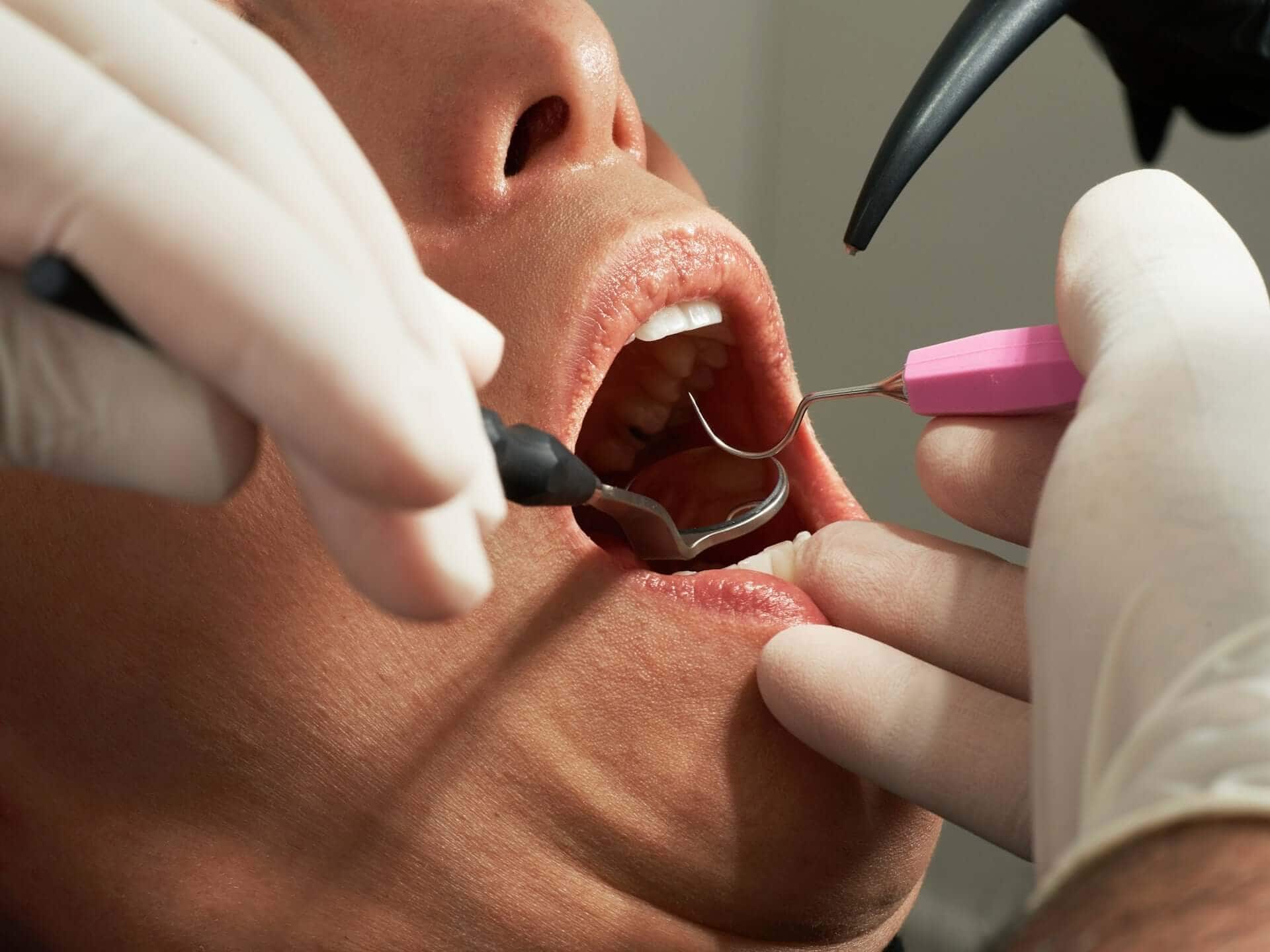 Dentist examining a patient’s teeth with dental instruments during a checkup to detect tooth decay, and other oral health concerns.