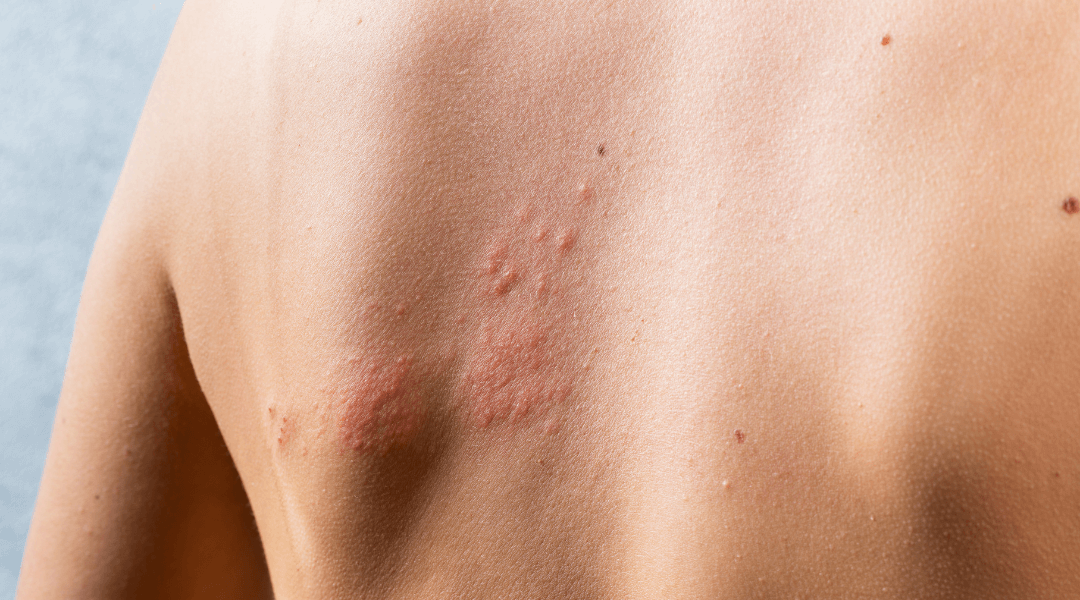 Perimenopause and Skin: Why Inflammation Hits Harder in Your 40s (And How to Calm It Down)