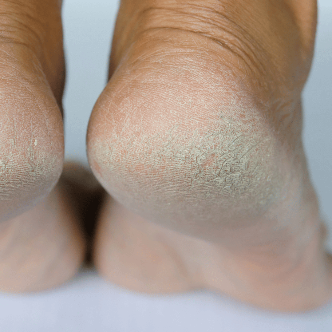 Causes Of Calluses