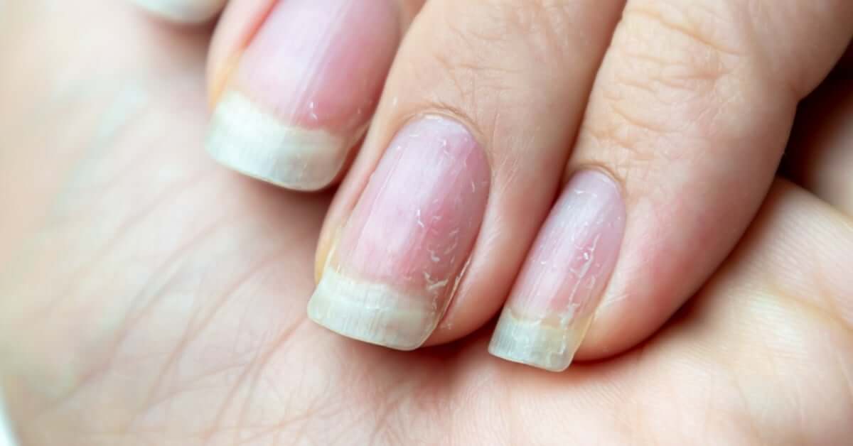 A close-up on a closed hand. The person's nails are rough in texture, with layers of damage and cracking on the surface.