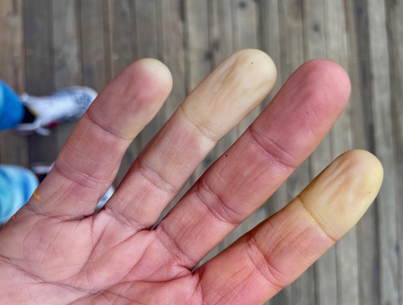 Who Treats Raynaud’s Disease?