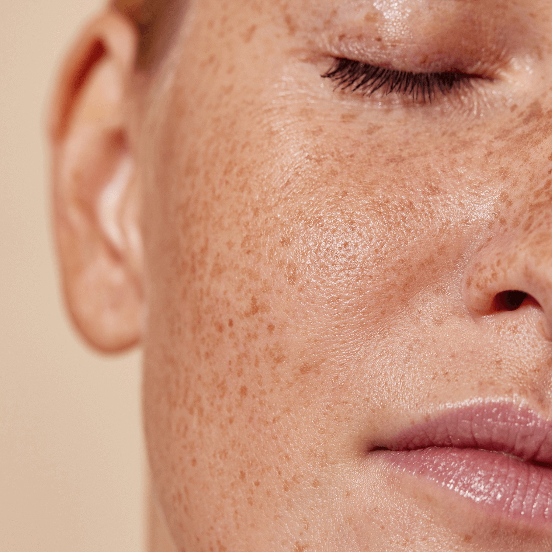 Hyperpigmentation and Summer
