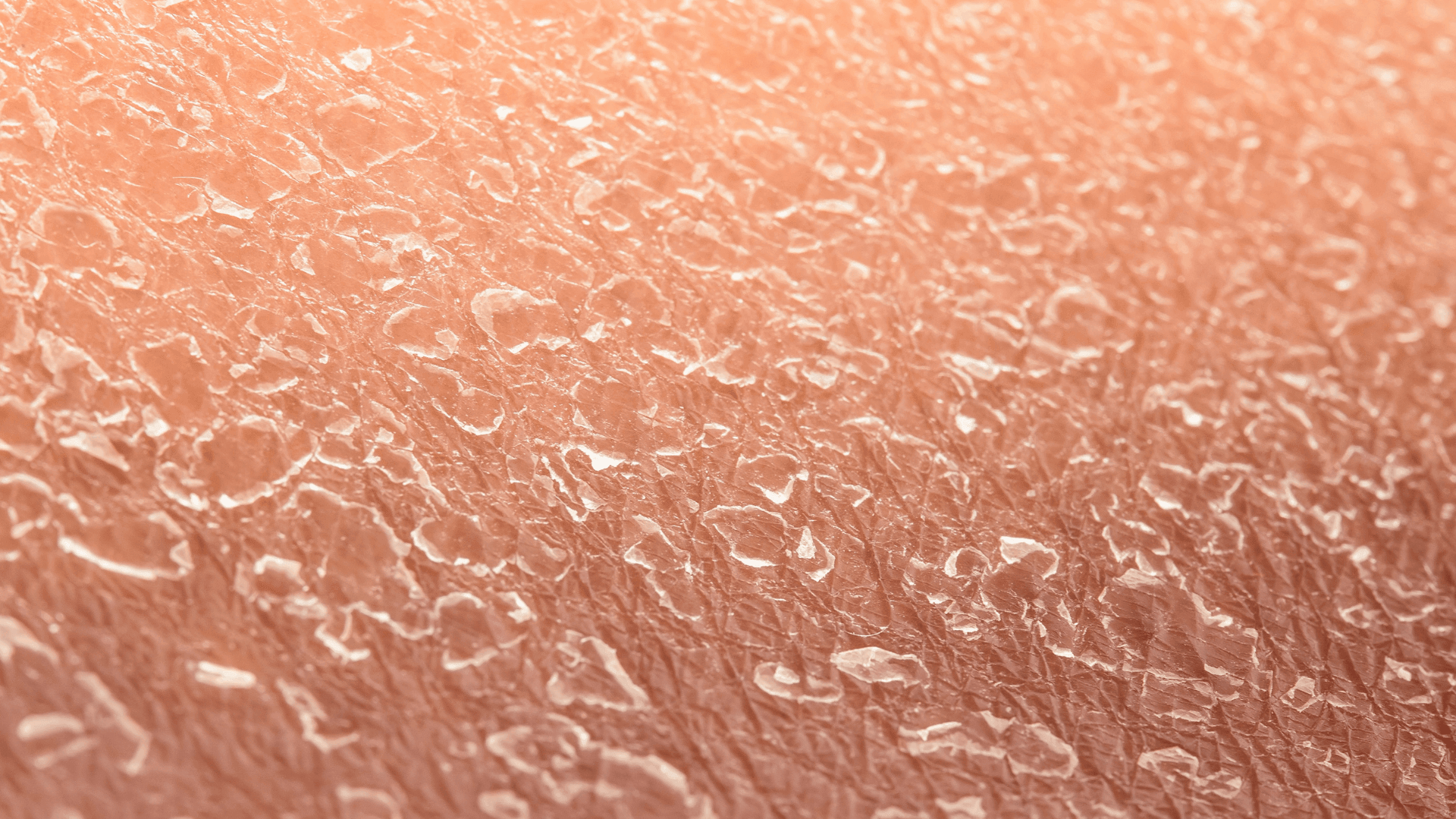 Understanding Flaky Skin on the Feet