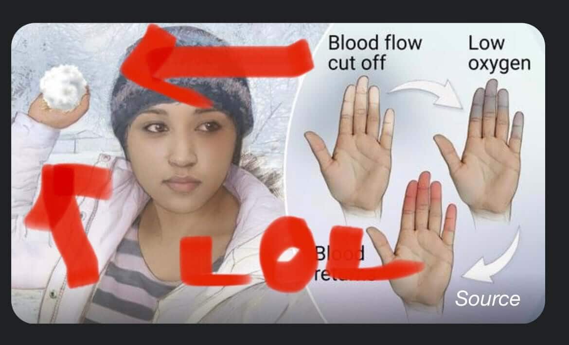 Raynaud’s example photo showing a woman holding a snowball with bare hands