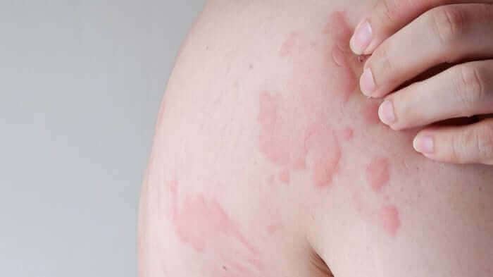 Close-up of skin showing red, raised hives and welts characteristic of chronic urticaria with hand touching affected area