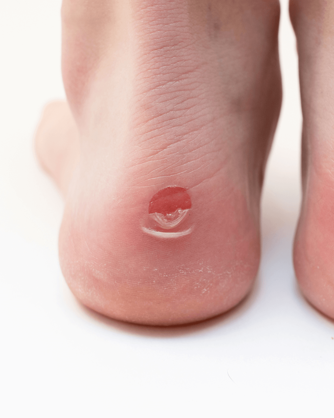 Blister