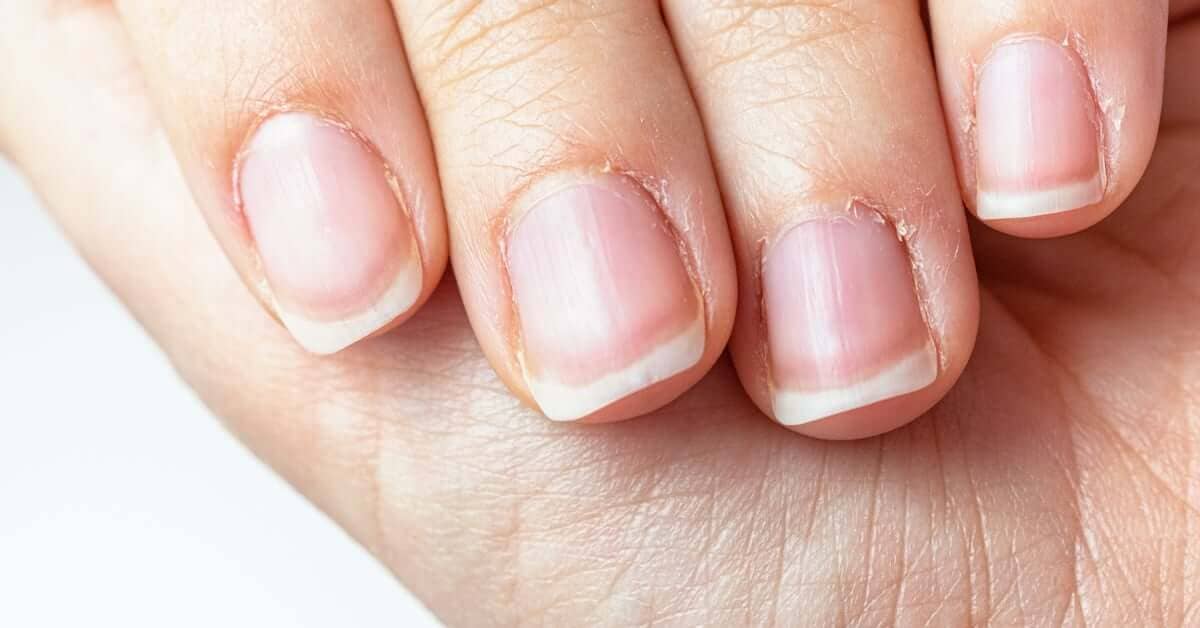 A close-up on a person's hand. Their nails are healthy, but the skin around them is dry, cracking, and uneven.