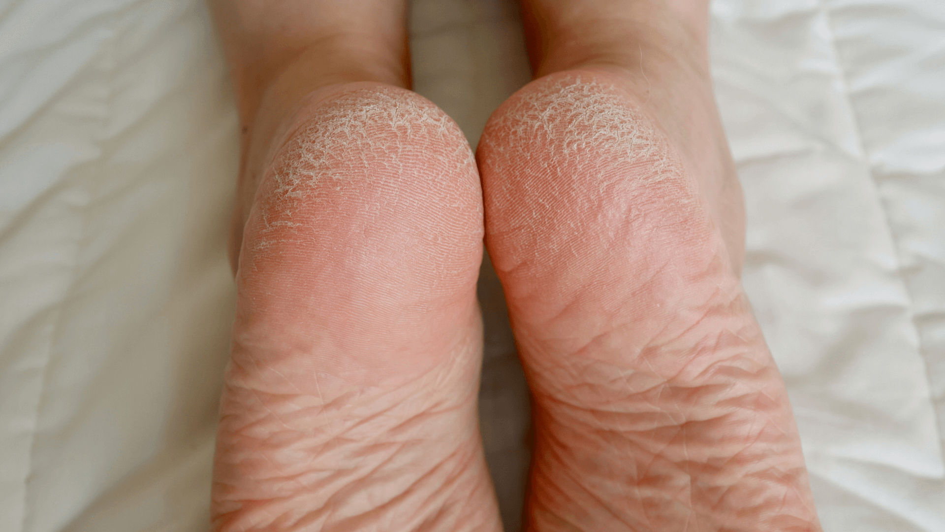 Cracked skin feet